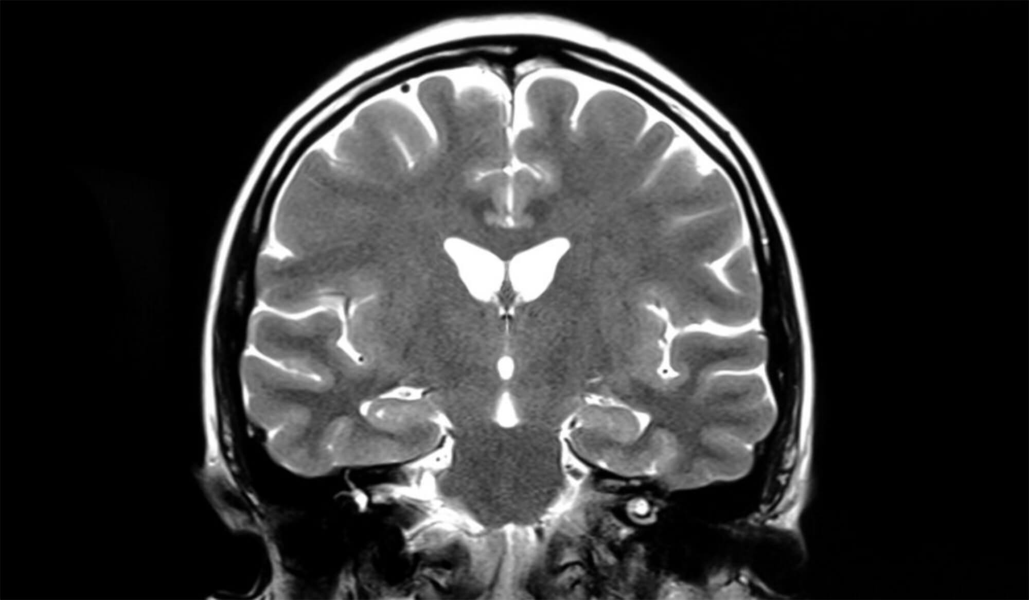 A brain butterfly